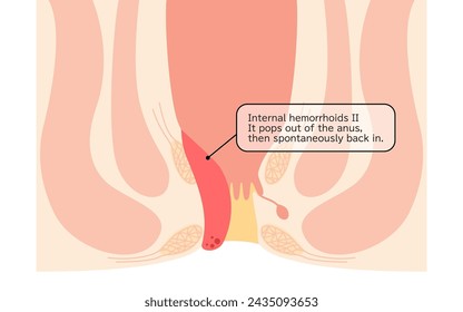 Erkrankungen des Anus, Hämorrhoiden und Warzen "Innere Hämorrhoiden, Grad II" Abbildung, Querschnitt - Übersetzung: Innere Hämorrhoiden, Grad II, Wenn es aus dem Anus herausspringt, spontan