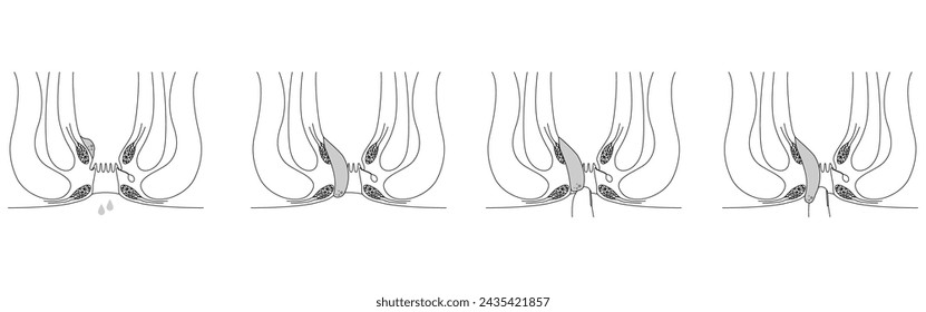 Diseases of the anus, hemorrhoids and warts "Internal hemorrhoids I-IV degree" Illustration, cross-sectional view, Vector Illustration