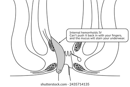 Diseases of the anus, hemorrhoids and warts "Internal hemorrhoids, degree IV" Illustration, cross-sectional view - Translation: Internal hemorrhoids, degree IV, Cannot be pushed back in with fingers, 