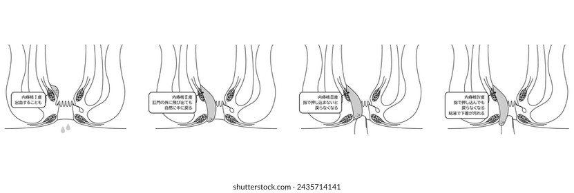 Enfermedades del ano, hemorroides y verrugas "Hemorroides internas grado I-IV" Ilustración, vista transversal - Traducción: Hemorroides internas, grado I ~ IV, sangrado, apareciendo pero regresando, 