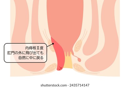 Diseases of the anus, hemorrhoids and warts "Internal hemorrhoids, degree II" Illustration, cross-sectional view - Translation: Internal hemorrhoids, degree II, If it pops out of the anus, it spontane
