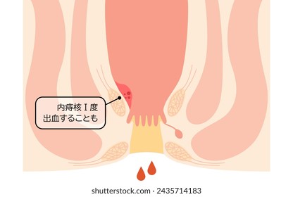 Diseases of the anus, hemorrhoids and warts "Internal hemorrhoids, degree I" Illustration, cross-sectional view - Translation: Internal hemorrhoids, degree I, may bleed