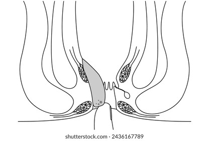 Enfermedades del ano, hemorroides y verrugas "Hemorroides internas, grado III" Ilustración, vista transversal, ilustración vectorial