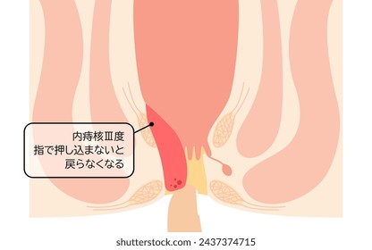 Diseases of the anus, hemorrhoids and warts "Internal hemorrhoids, degree III" Illustration, cross-sectional view - Translation: Internal hemorrhoids, degree III, You have to push it in with your fing
