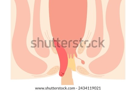 Diseases of the anus, hemorrhoids and warts "Internal hemorrhoids, degree IV" Illustration, cross-sectional view, Vector Illustration