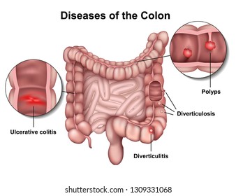 Diseases of the colon 3d medical vector illustration on white background