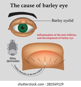 Diseases of the eye barley. Causes of barley. Demodex mite infestations. Inflammation volosyannoy bulbs.