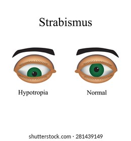Diseases of the eye - strabismus. A variation of strabismus - Hypotropia.