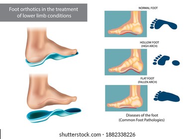 Diseases Of The Foot. Common Foot Pathologies. Foot Orthotics In The Treatment Of Lower Limb Conditions