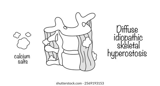 Diseases of the musculoskeletal system in which calcium salts are deposited in the area of ligaments and tendons. Simple vector illustration for different uses.