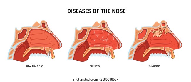 Diseases of nose anatomical cross section with healthy nose sinusitis and rhinitis realistic vector illustration