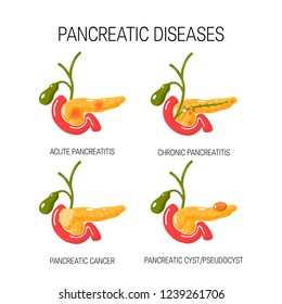 Diseases Of The Pancreas Concept. Medical Vector Illustration Of Acute And Chronic Pancreatitis, Pancreatic Cyst Ans Cancer.