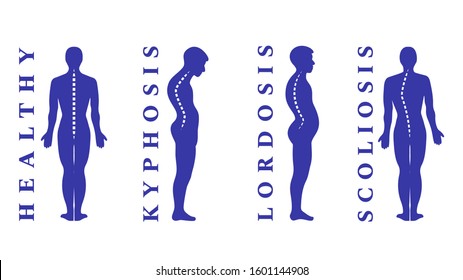 Diseases of the spine. Scoliosis, lordosis, kyphosis. Body posture defects. Back curvature. Spinal deformity types. Medical disease infographic. Diagnostic symptom. Vector illustration.