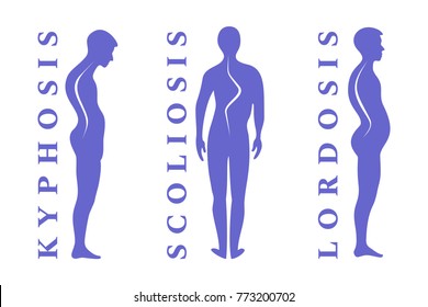 Diseases of the spine. Scoliosis, lordosis, kyphosis. Body posture defect. Human silhouettes isolated on white, vector illustration.