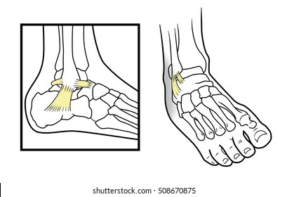 Dislocated ankle diagram on a white background
