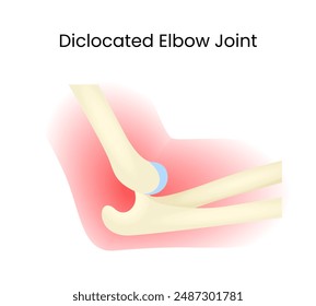 Dislocated Elbow Joint Vector Design