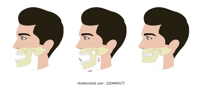 dislocated Jaw vector illustration first aid