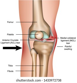 Dislocated Knee, Medial Collateral Ligament Tear Medical Vector Illustration Isolated On White Background