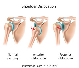 Dislocated shoulder