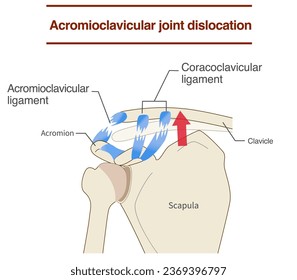 Dislocation of the acromioclavicular joint and ligaments and its mechanism - Shutterstock ID 2369396797