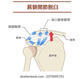 Dislocation of the acromioclavicular joint and ligaments and its mechanism ;Translate Acromioclavicular joint dislocation