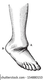 Verlagerung des Fußrückens, vintage gravierte Abbildung. Übliches Medizin-Wörterbuch - Paul Labarthe - 1885.