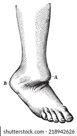 Verlagerung des Fußrückens, vintage gravierte Abbildung. Übliches Medizin-Wörterbuch - Paul Labarthe - 1885. 
