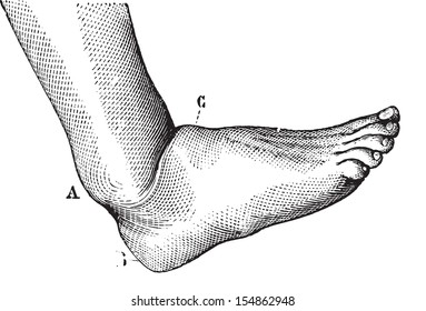 Verlagerung des Fußes nach vorn, vintage gravierte Illustration. Übliches Medizin-Wörterbuch - Paul Labarthe - 1885.