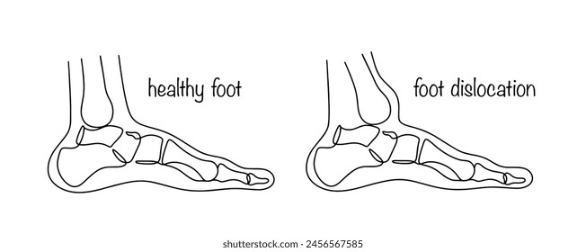 Dislocation of the foot. The result of an injury in which the relationship of the bones in the joint is disrupted and they take an atypical position. A healthy leg and a leg with a displaced tibia.