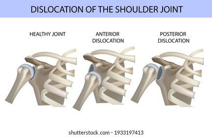 Dislocation of the shoulder joint, medical vector illustration