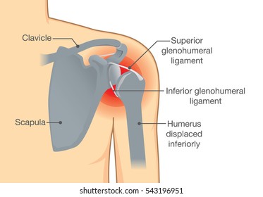 Dislocation Shoulder symptoms or separated. Bone and joints to slipping out of place.
