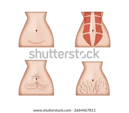 Displaying four perspectives of a female lower torso, highlighting common aesthetic concerns such as c section scars, diastasis recti, skin flaccidity, and stretch marks
