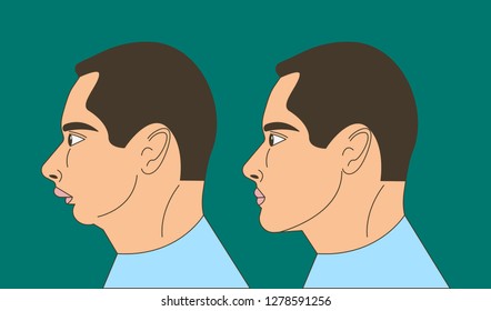 Distal bite, man with malocclusion, lower jaw pushing back, bite correction by braces. Vector illustration