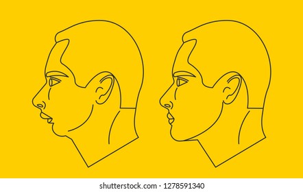 Distal bite, man with malocclusion, lower jaw pushing back, bite correction by braces. Vector illustration