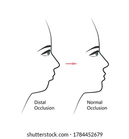 Distal bite profile before and after orthodontic treatment. Human with malocclusion, lower jaw pushing back, bite correction by braces. Vector illustration.