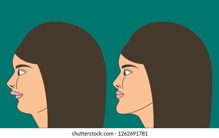 Distal bite, woman with malocclusion, lower jaw pushed back, bite correction by braces. Vector illustration