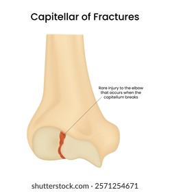 Distal Humerus of Capitellum Fracture