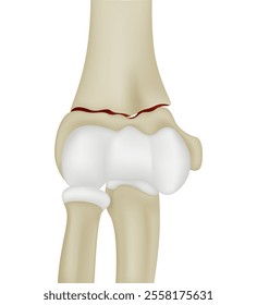 Distal Humerus Fractures of Elbow