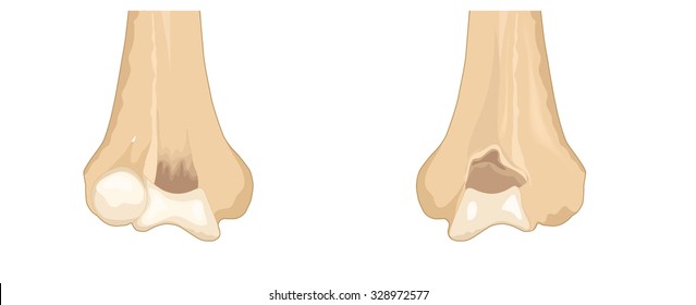 The distal humerus showing the major anatomical features and sites of major muscle attachments.