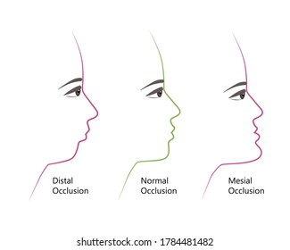 distal, Normal, and Mesial bite profile, vector illustration. Overbite or underbite before and after orthodontic treatment. Human with malocclusion, bite correction by braces concept.