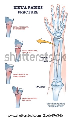 Distal radius fracture and broken arm bone types anatomy outline diagram. Labeled educational scheme with extra articular nondisplaced and displaced radius and ulna comparison vector illustration.