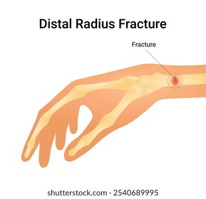 Fratura Do Raio Distal Do Pulso Quebrado