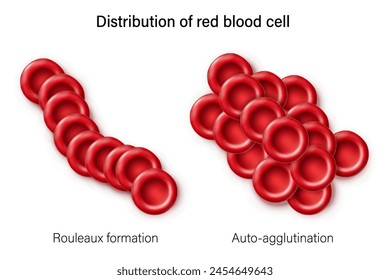 Distribution of red blood cell. Auto-agglutination and Rouleaux formation. Red blood cell morphology. 