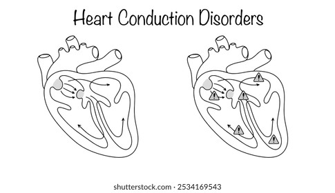 Alteración en la propagación de impulsos eléctricos a lo largo de los Paquetes nerviosos dentro de las aurículas y ventrículos. Dibujado corazón sano y un corazón con trastornos de conducción. Vector de línea médica.