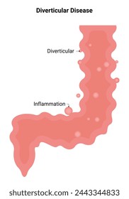 Diagrama de ilustración vectorial de diseño científico de enfermedad diverticular