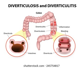 Diverticulosis and Diverticulitis. Diverticula are pockets that develop in the colon wall. These small pouches bulge outward through weak spots in the colon wall.