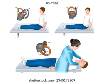 Dix-Hallpike test is a diagnostic maneuver from a group of rotational tests used to detect benign paroxysmal positional vertigo (BPPV). Right ear. vector realistic