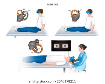 Dix-Hallpike test is a diagnostic maneuver from a group of rotational tests used to detect benign paroxysmal positional vertigo (BPPV) with glasses. Right ear. vector realistic