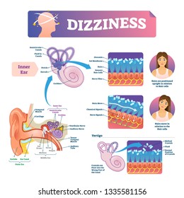 Dizziness vector illustration. Labeled medical scheme with inner ear and vertigo. Educational closeup diagram with rotating and unstable head feeling cause. Anatomical vestibular problem explanation.