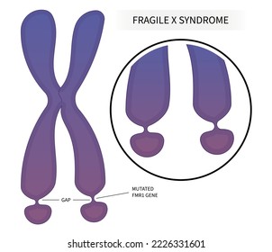 DNA disorder testing of Fragile x syndrome with ADHD and for elongated face flat feet protruding ears inherited health depression forehead disability prominent jaw